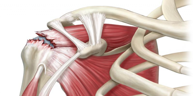 EFICACIA DE LA FISIOTERAPIA EN TENDINITIS Y ROTURAS DEL MANGUITO DE LOS ROTADORES