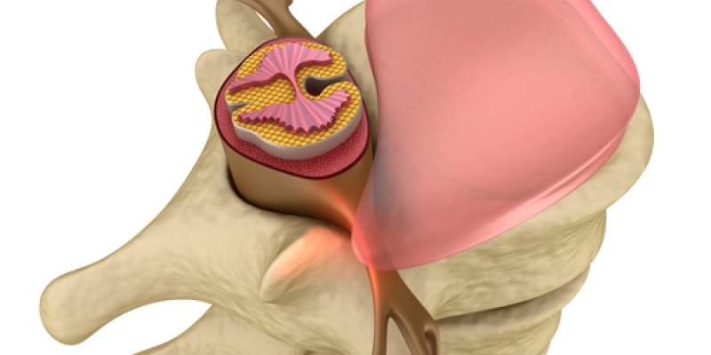 HERNIA DISCAL L5-S1: ¿QUÉ ES Y COMO TRATARLA?